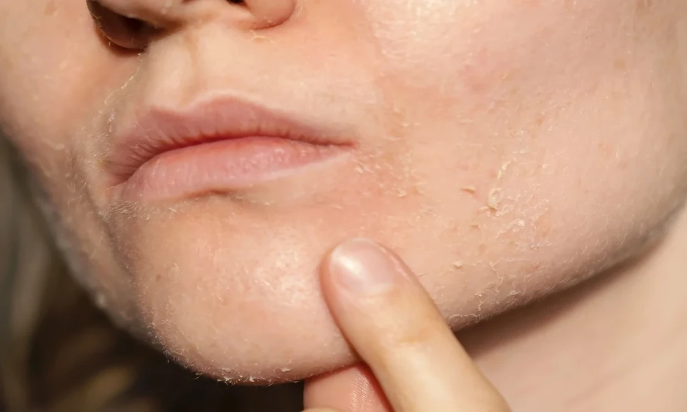 A PRACTICAL LOOK AT SEASONAL WEATHER EFFECTS ON YOUR SKIN BARRIER